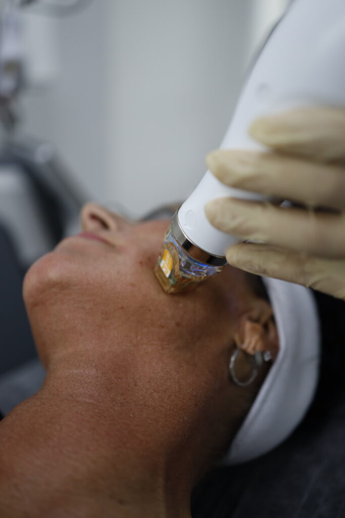 Microneedling RF in Heilbronn
