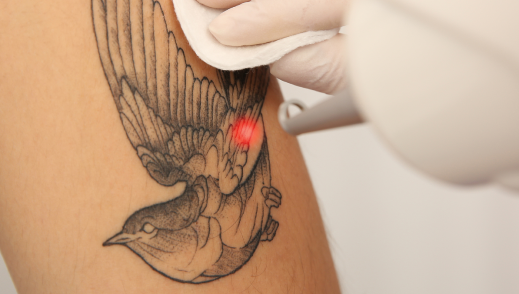 Tattooentfernung Heilbronn